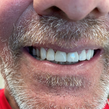 Dental Crowns/Cosmetic Dentistry Before