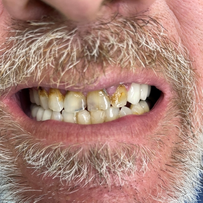 Dental Crowns/Cosmetic Dentistry After