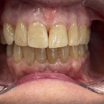 Clear Aligner Therapy After