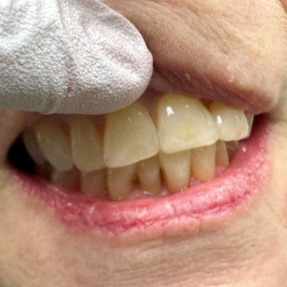 Cosmetic Bonding After