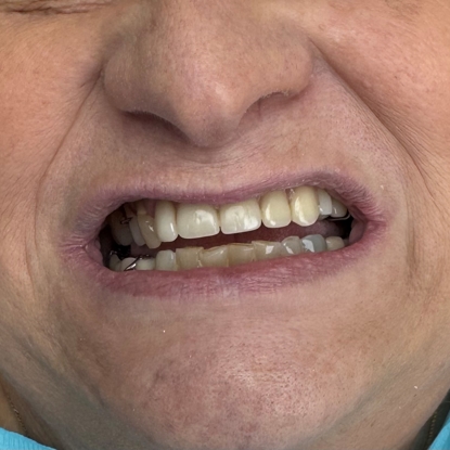 Partial Denture After