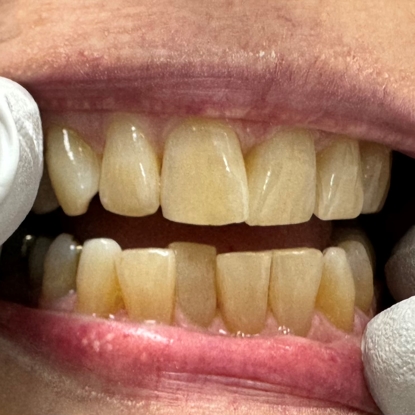 Clear Aligner Therapy Before