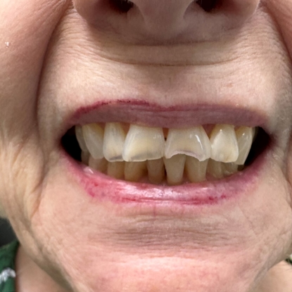 Cosmetic Bonding Before