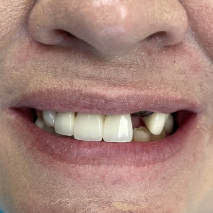 Dental Implant Before