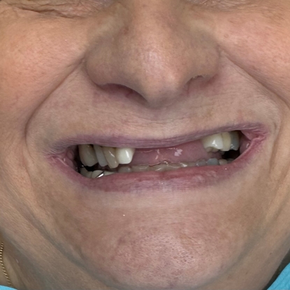 Partial Denture Before